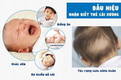 dấu hiệu trẻ còi xương